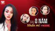  Sau 8 năm nhấn mí có bị tuột sụp nếp mí không hãy hỏi cô nàng Việt Kiều này