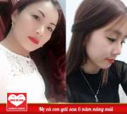  Muốn “lột xác” dáng mũi thấp tẹt không có sống hãy hỏi mẹ con cô nàng sau 6 năm nâng mũi này