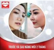 Sa Miên hậu nâng mũi: “Cuộc đời hay bị sai nên phải sửa…” Tuyên ngôn của những cô nàng thời hiện đại