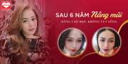 Đập tan nỗi lo nâng mũi vài năm tụt sống với phương pháp nâng mũi này…