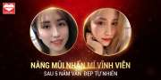  Sau 5 năm nâng mũi nhấn mí vẫn giữ được vẻ đẹp như ngày đầu