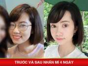 Trải lòng sau 15 năm cắt mí mắt tại Mika Vũ Thái của Tina Đào