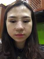  Diễn biến từng ngày sau nâng mũi nhấn mí và bí quyết chống sưng bầm tím 