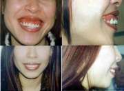 Phẫu thuật chữa cười hở lợi ở đâu tốt và an toàn