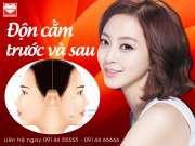 6 điều cần bắt buộc phải biết trước và sau độn cằm