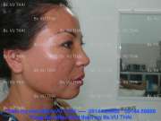 Người phụ nữ 10 năm sau nâng mũi giờ ra sao…