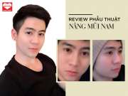 Nâng mũi nam: Lời chia sẻ sau 10 năm nâng mũi của 2 NAM THẦN