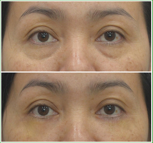 Bóc mỡ mắt giúp bạn có gương mặt trẻ trung hơn