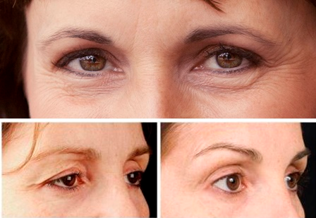 Phẫu thuật treo cung mày phù hợp áp dụng cho nhưng ai?