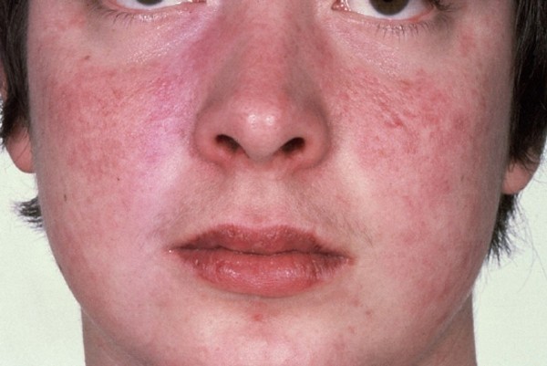 Có những trường hợp đỏ toàn phần đầu mũi