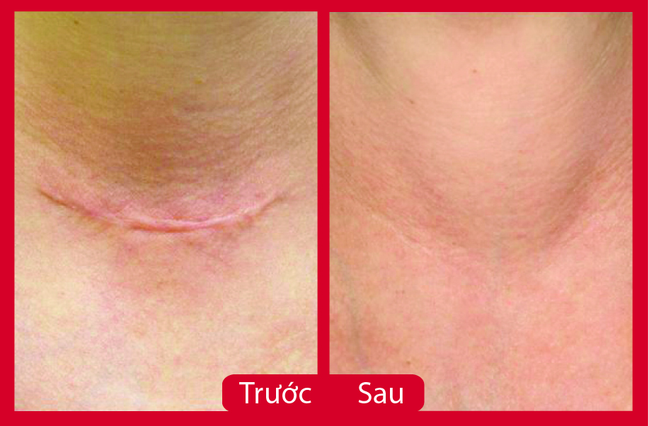 Trước và sau khi phẫu thuật điều trị sẹo tại Mika Vũ Thái