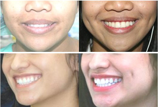 Phẫu thuật tạo má lúm đồng tiền giúp bạn trở nên xinh xắn hơn