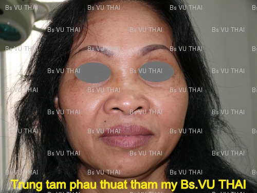 Đầu mũi to khiến khuôn mặt trở nên kém duyên dáng