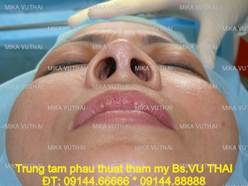 Trước khi thực hiện phẫu thuật thu nhỏ lỗ mũi