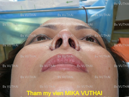 Sau thu nhỏ lỗ mũi, bạn sẽ có chiếc mũi đẹp tư nhiên, thon gọn hơn