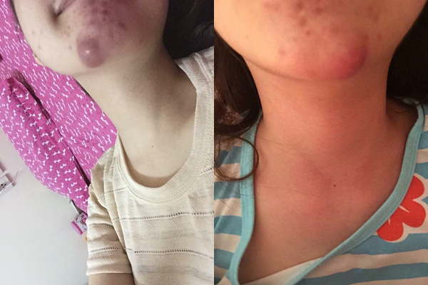 Đây là tình trạng bị sưng nặng do tiêm filler do không rõ nguồn gốc